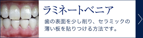 ラミネートベニア