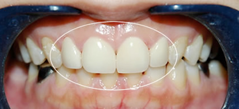 治療の流れ セラミックシェルと天然歯を接着