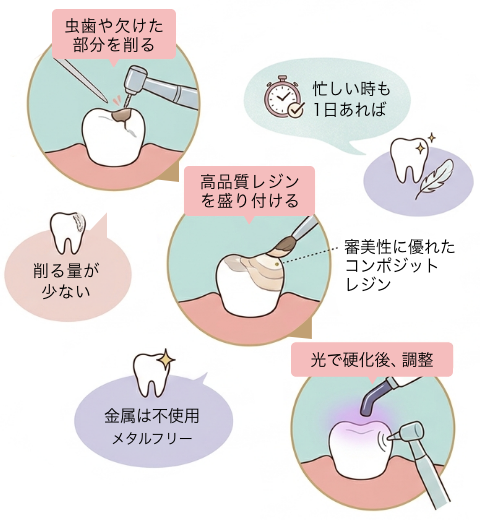 ダイレクトボンディングの説明