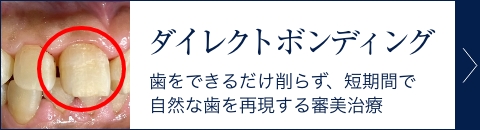 ダイレクトボンディング