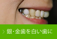 銀･金歯を白い歯に
