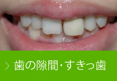 歯の隙間･すきっ歯