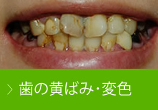 歯の黄ばみ･変色