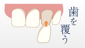 歯を覆う