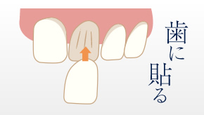 歯に貼る