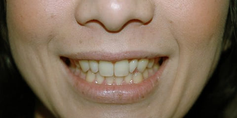 笑うと歯茎が出てしまう ｎセントラルクリニック歯科