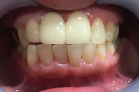 前歯のすき間と出っ歯を治療後1