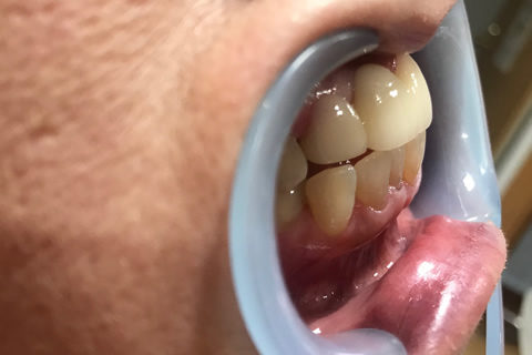 前歯のすき間と出っ歯を治療後2