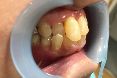前歯のすき間と出っ歯を治療前2