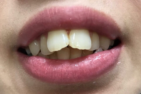 出っ歯の改善でセラミッククラウン ｎセントラルクリニック歯科