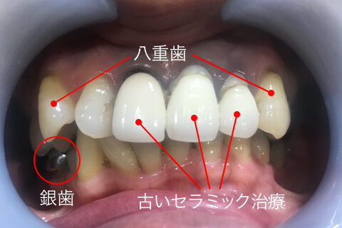 虫歯と八重歯とセラミッククラウンのやり直し ｎセントラルクリニック歯科